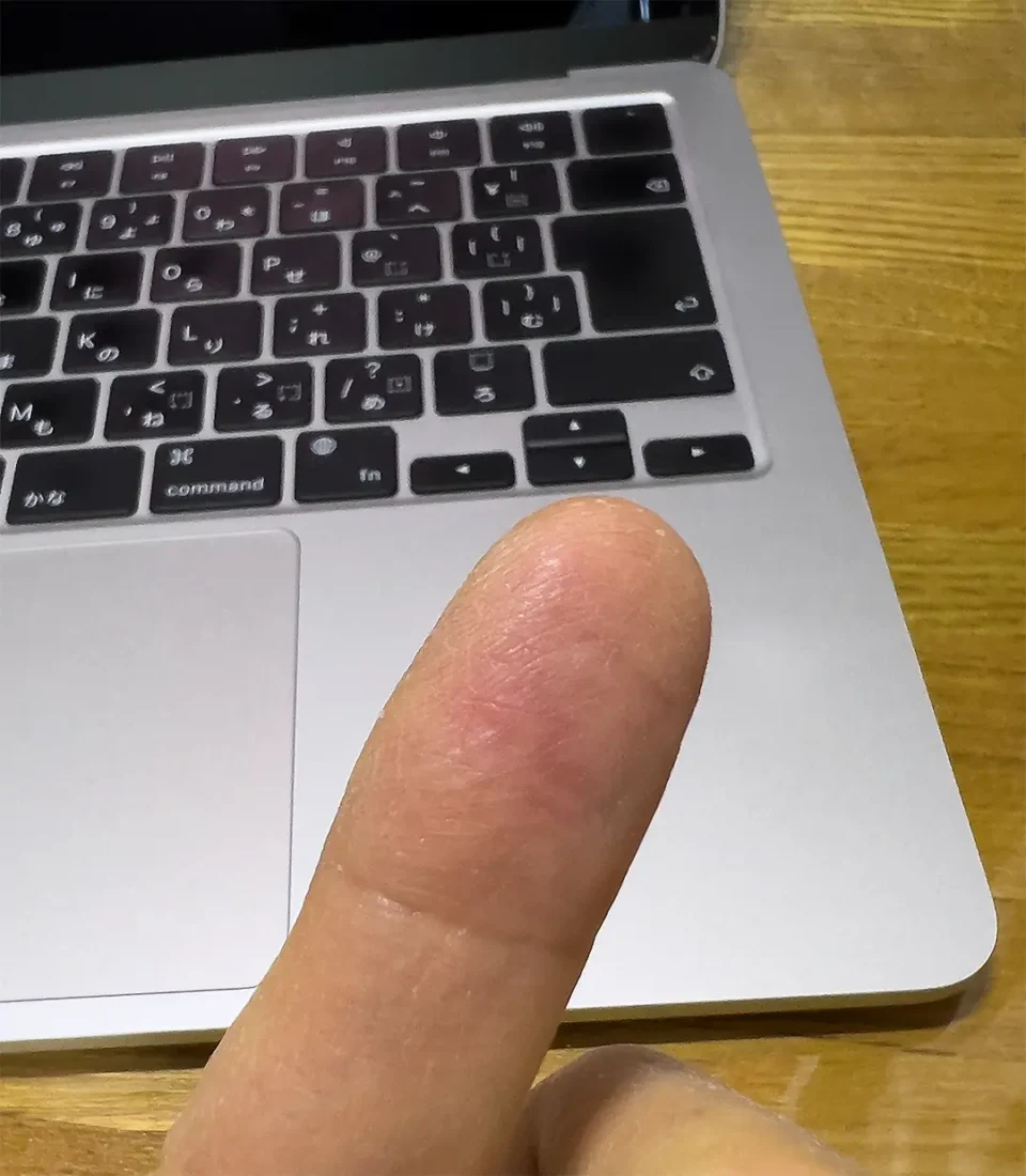 指先がカサカサ